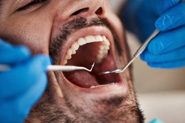 Best Emergency Treatment for Dental Infections or Abscesses in Pce, LA